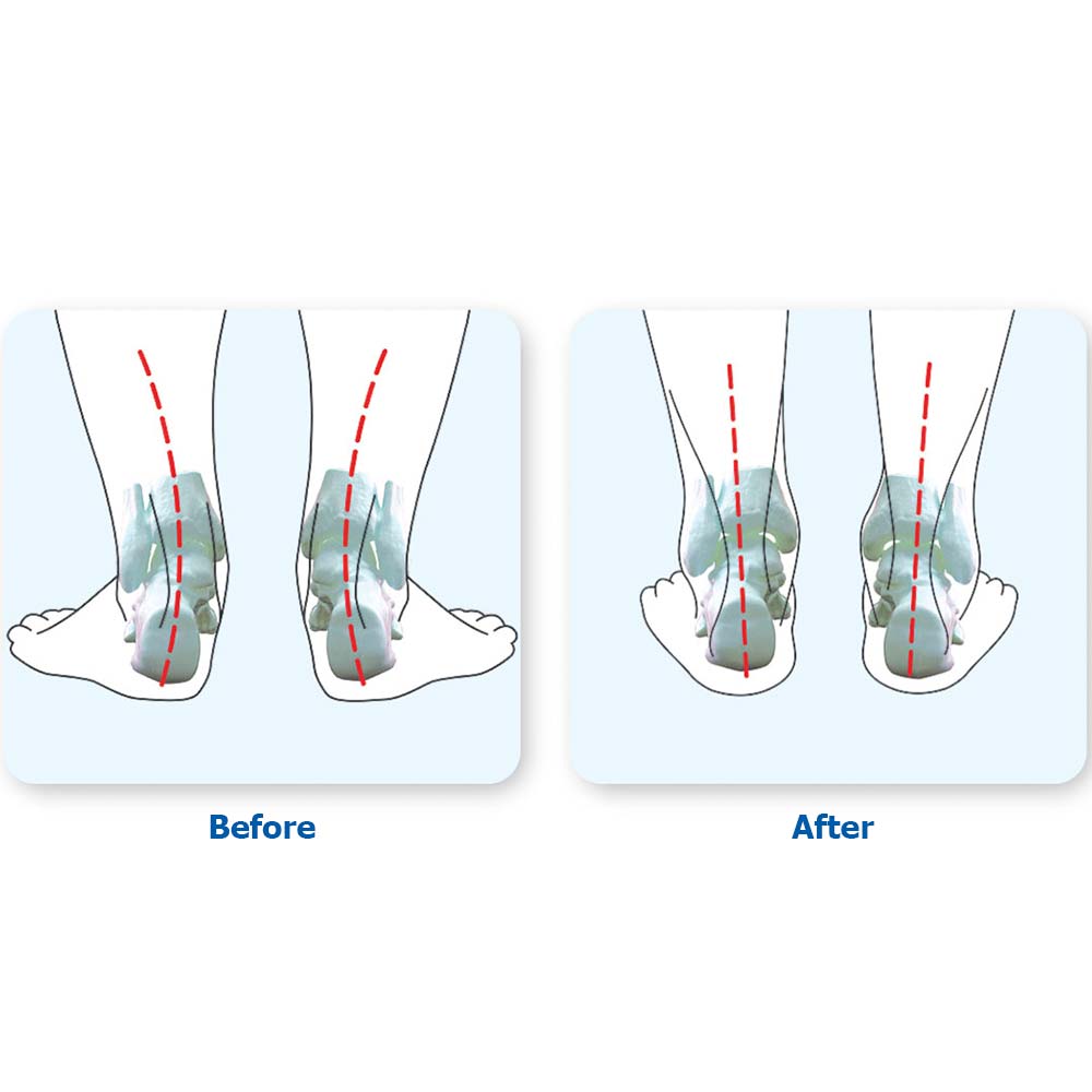 Orthofit Orthotics with/without Metatarsal Dome | Various Sizes | 1 Pair